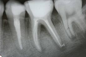 root canal